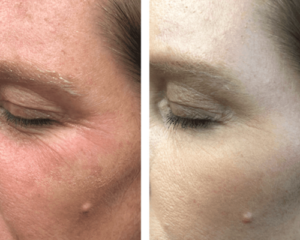 Skin Rejuvenation Before & After | The Skin Clinic MedSpa | Mankato