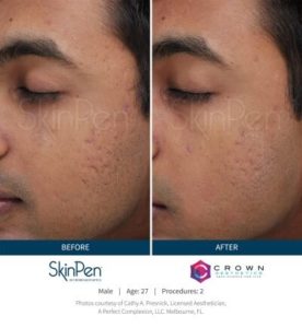 Microneedling Before & After | The Skin Clinic MedSpa | Mankato