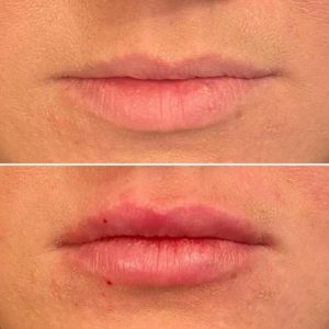 Dermal Fillers Before & After | The Skin Clinic MedSpa | Mankato