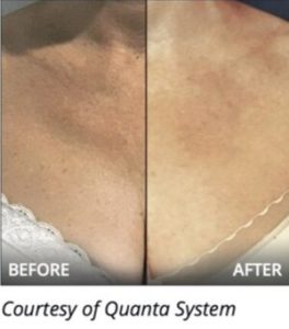 Laser Treatment Before & After | The Skin Clinic MedSpa | Mankato