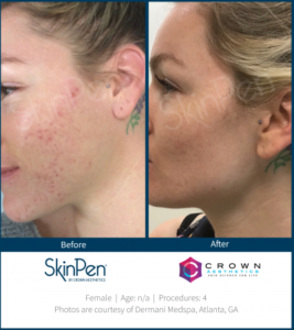 Skinpen Before & After | The Skin Clinic MedSpa | Mankato