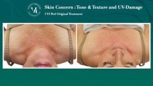 VI Peel Before & After | The Skin Clinic MedSpa | Mankato