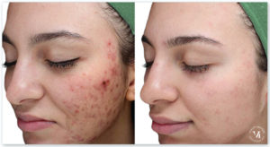 VI Peel Before & After | The Skin Clinic MedSpa | Mankato