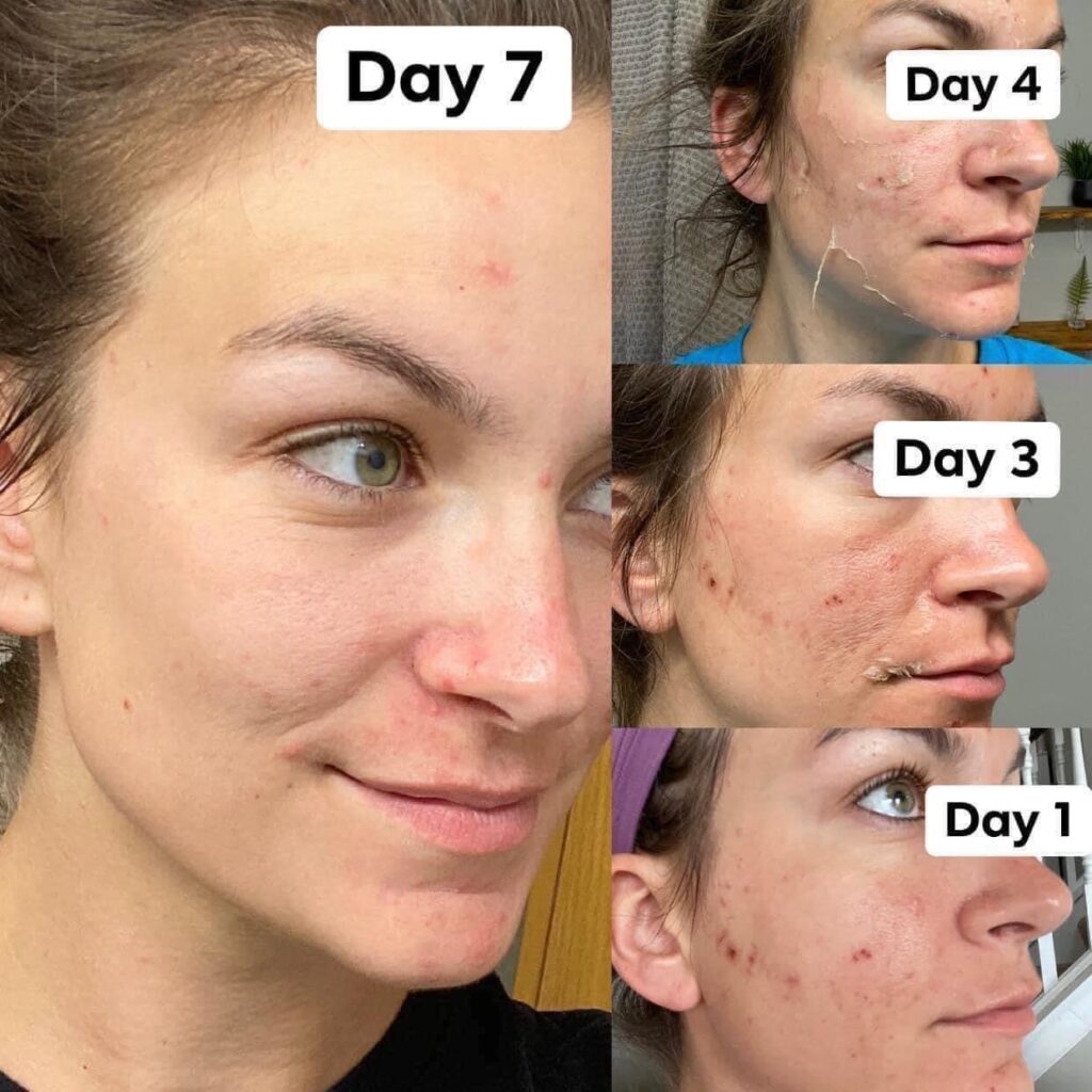 VI Peel Before and After