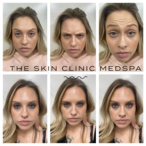 Botox | The Skin Clinic MedSpa | Mankato