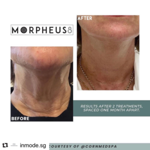 Morpheus8 | The Skin Clinic MedSpa | Mankato