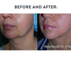 Morpheus8 Before & After | The Skin Clinic MedSpa | Mankato