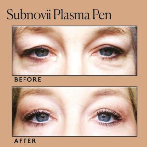 Plasma Pen | The Skin Clinic MedSpa | Mankato