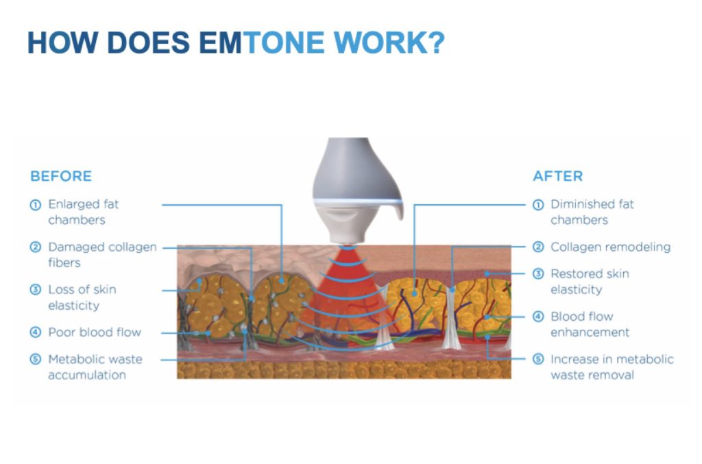 Emtone in Mankato, MN | The Skin Clinic MedSpa