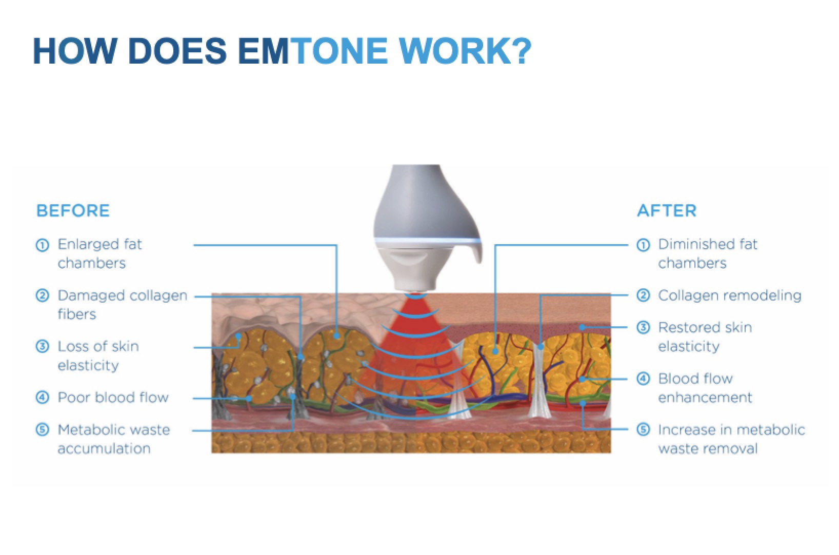 Emtone in Mankato, MN | The Skin Clinic MedSpa