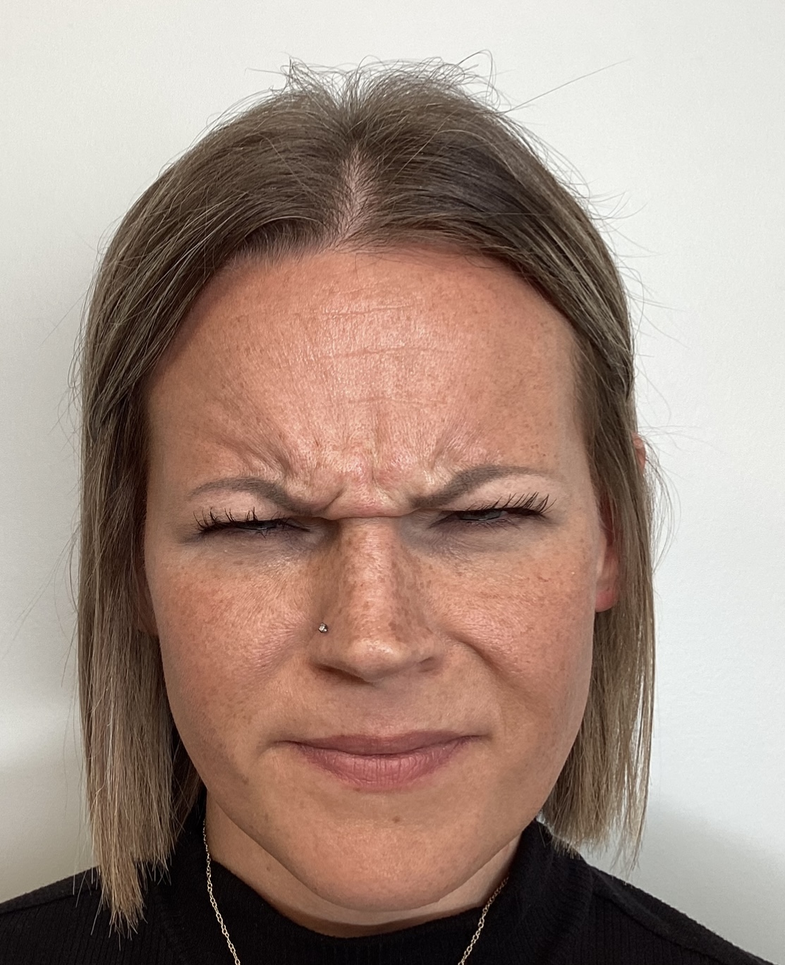 Botox treatment