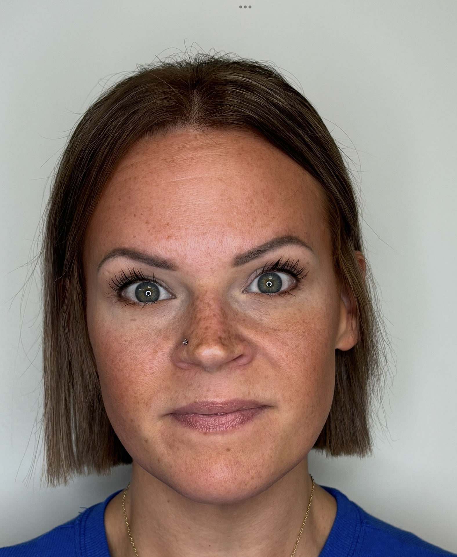 Botox Treatment for wrinkles