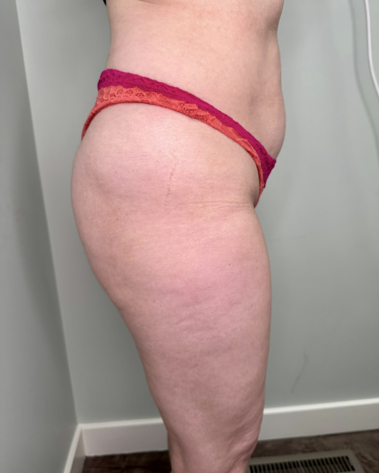 Get stronger, leaner, and more toned with EMSCULPT NEO. FDA-cleared, no downtime, just powerful body contouring.