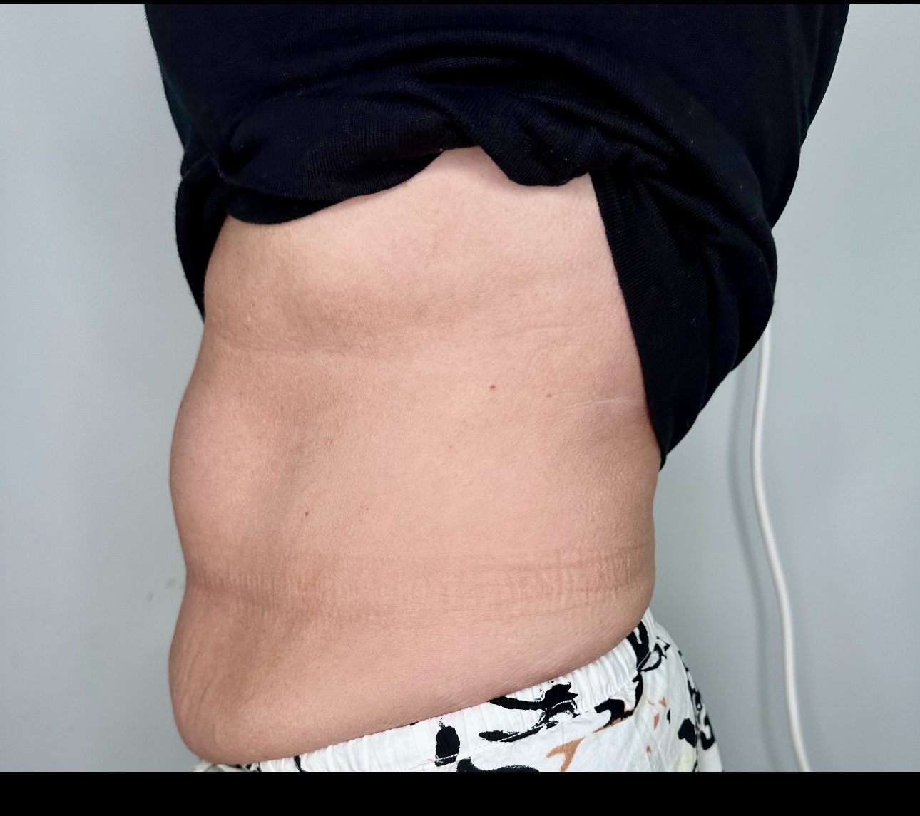 Build muscle and burn fat with EMSCULPT NEO at The Skin Clinic. Non-invasive body sculpting with real, lasting results.