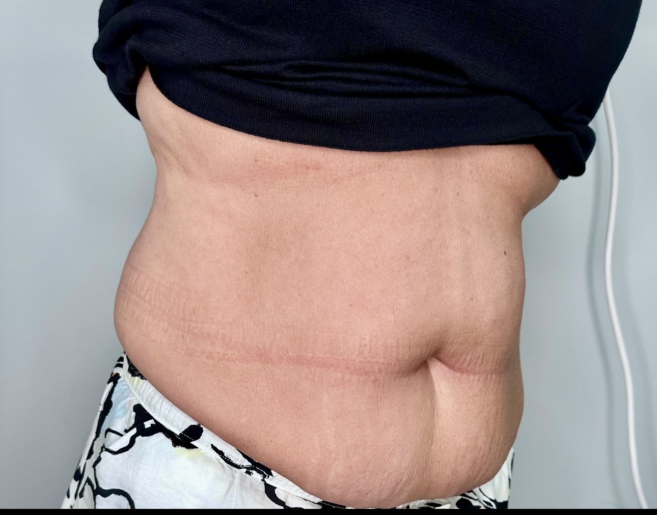 Emsculpt Neo Body Contouring