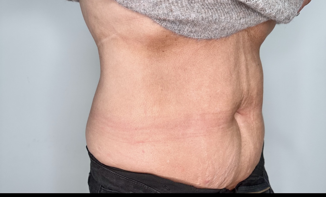 Emsculpt Neo Body Contouring