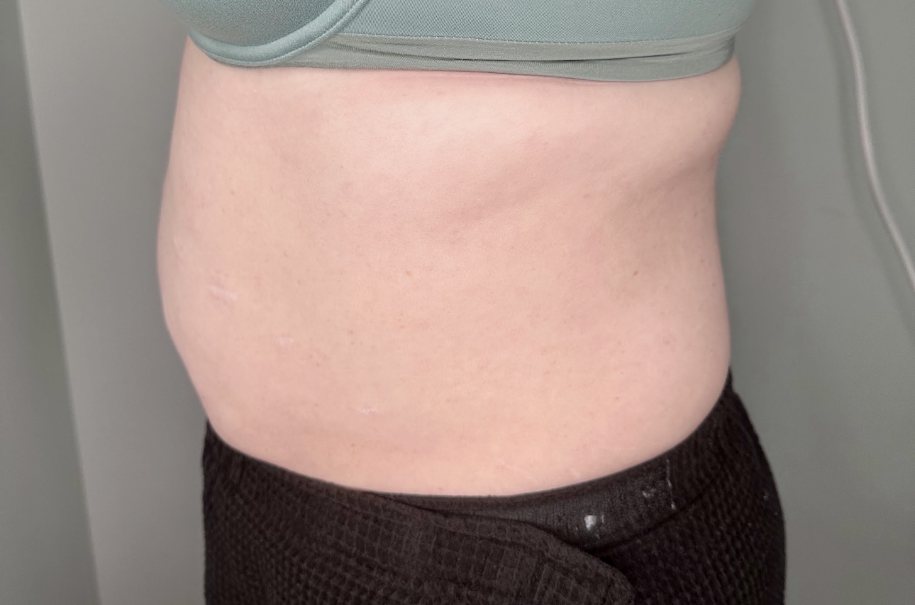 EMSCULPT Neo Body Contouring