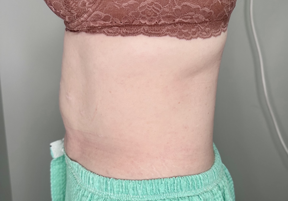 EMSCULPT Neo Body Contouring