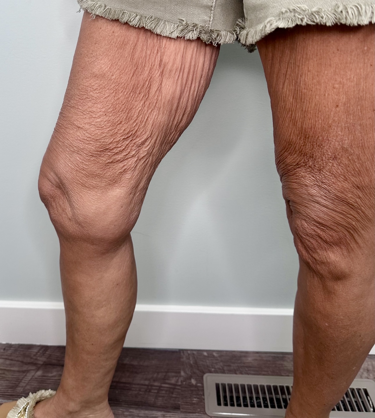 Sculpt muscle, burn fat, and tighten skin with EMSCULPT NEO + Exion Body at The Skin Clinic. Advanced body contouring, no surgery required.