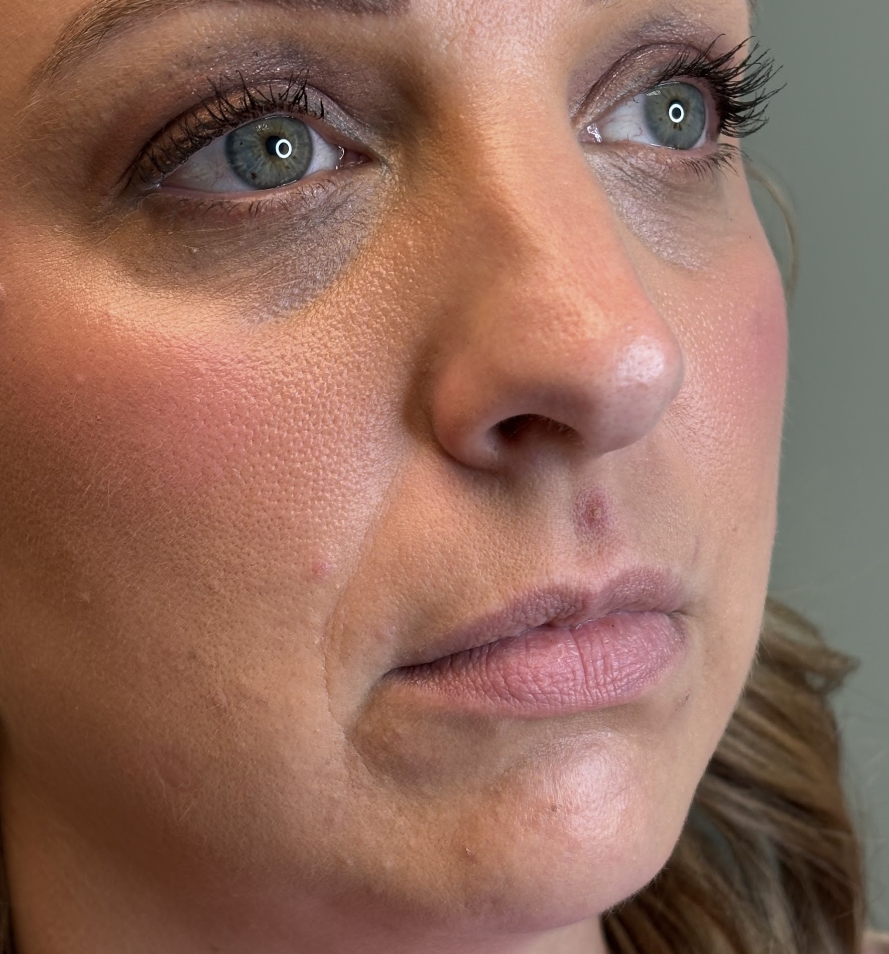 lip filler