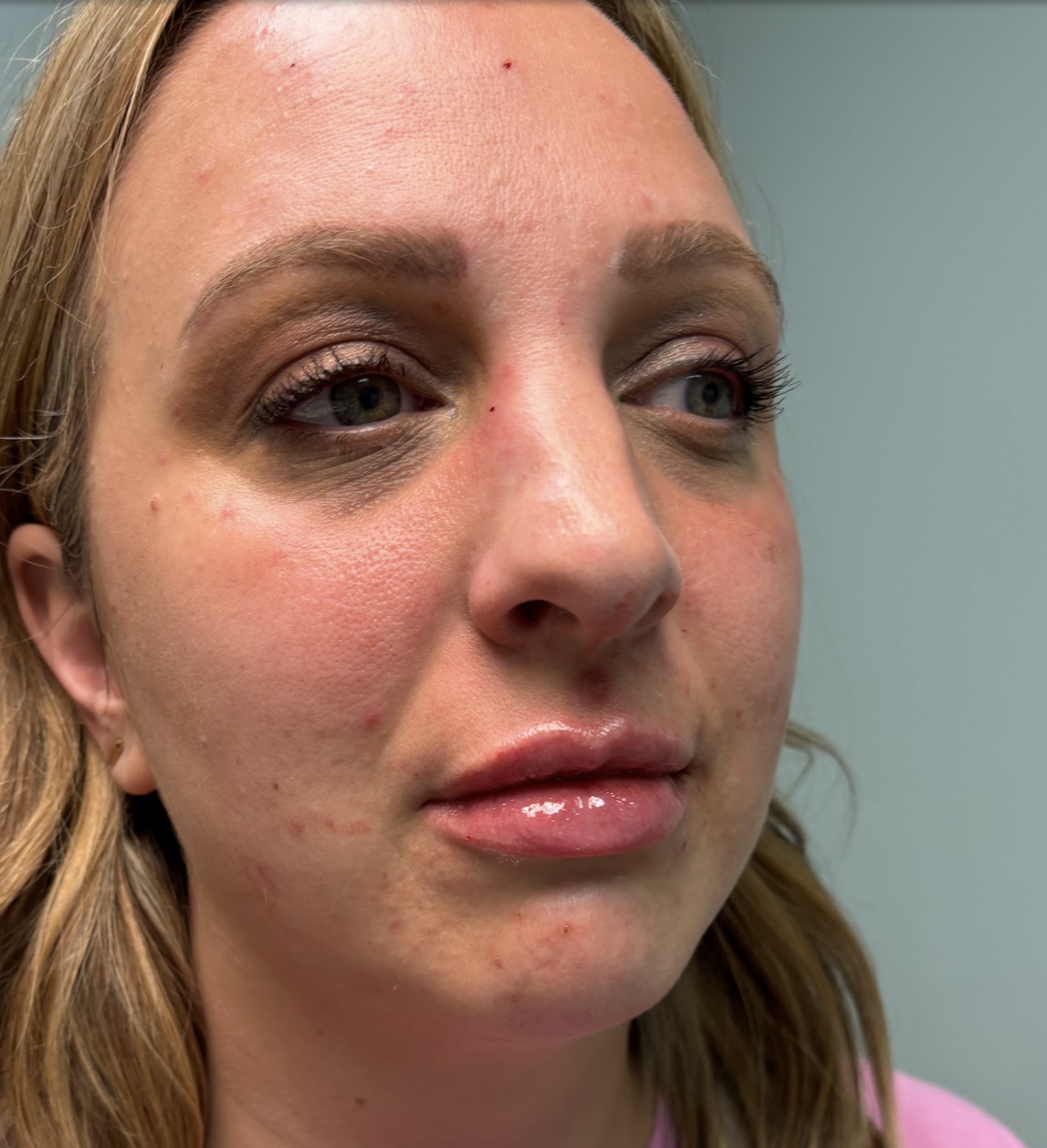Lip Filler