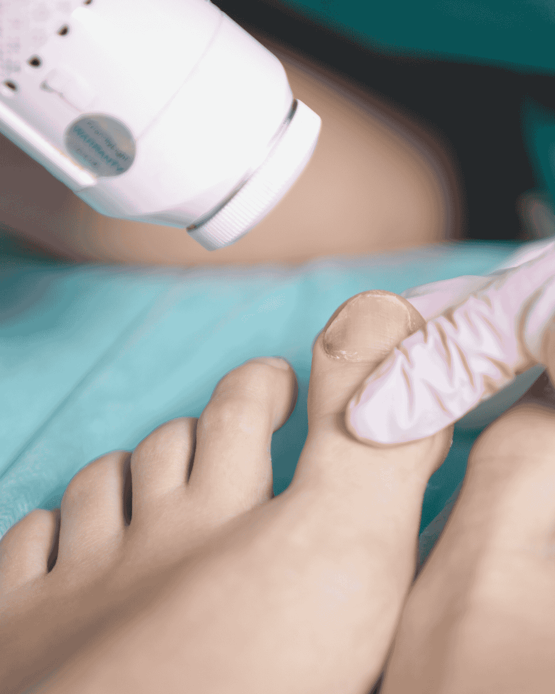 Laser Nail Fungal Treatment