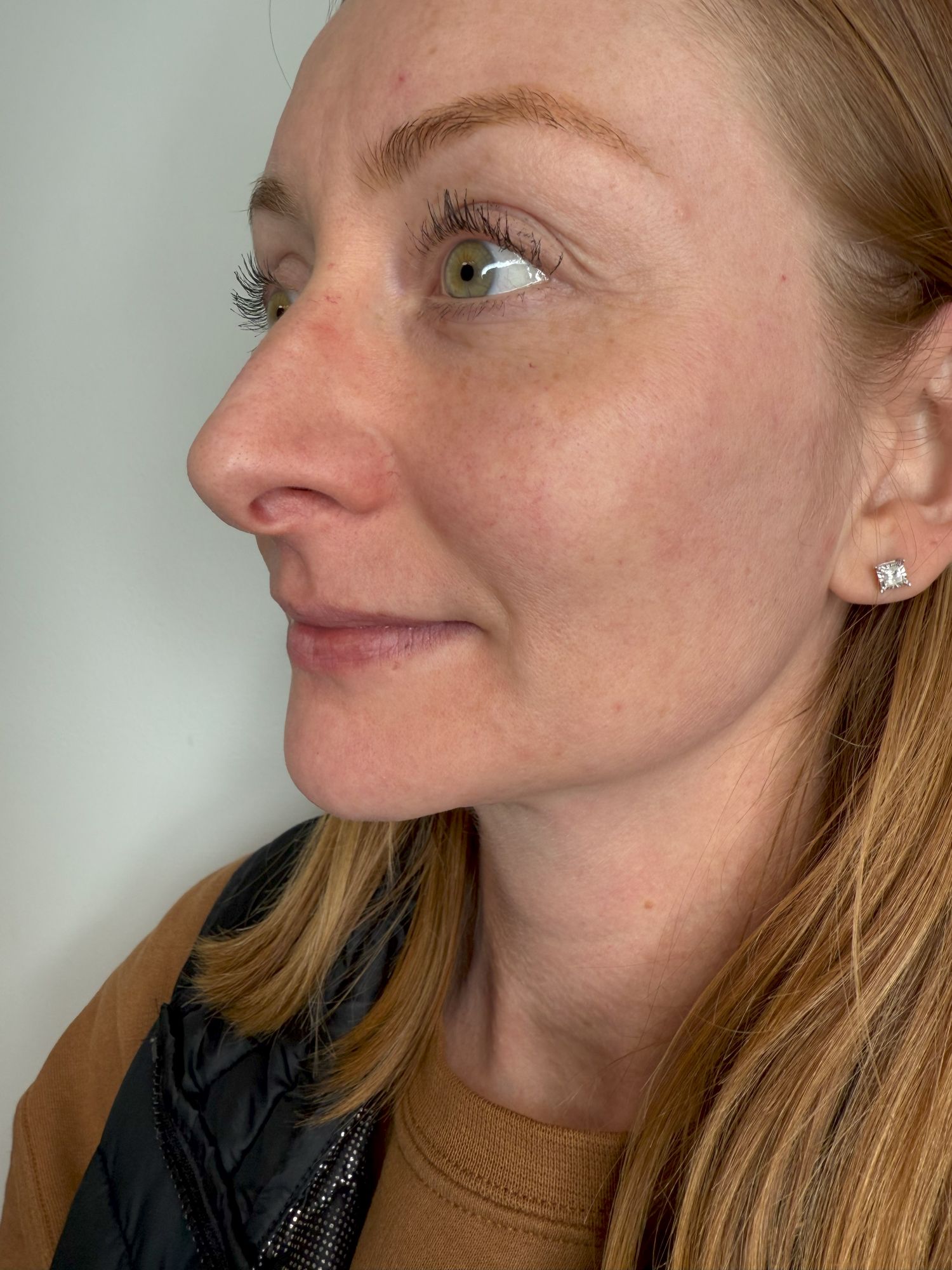 Lip Filler