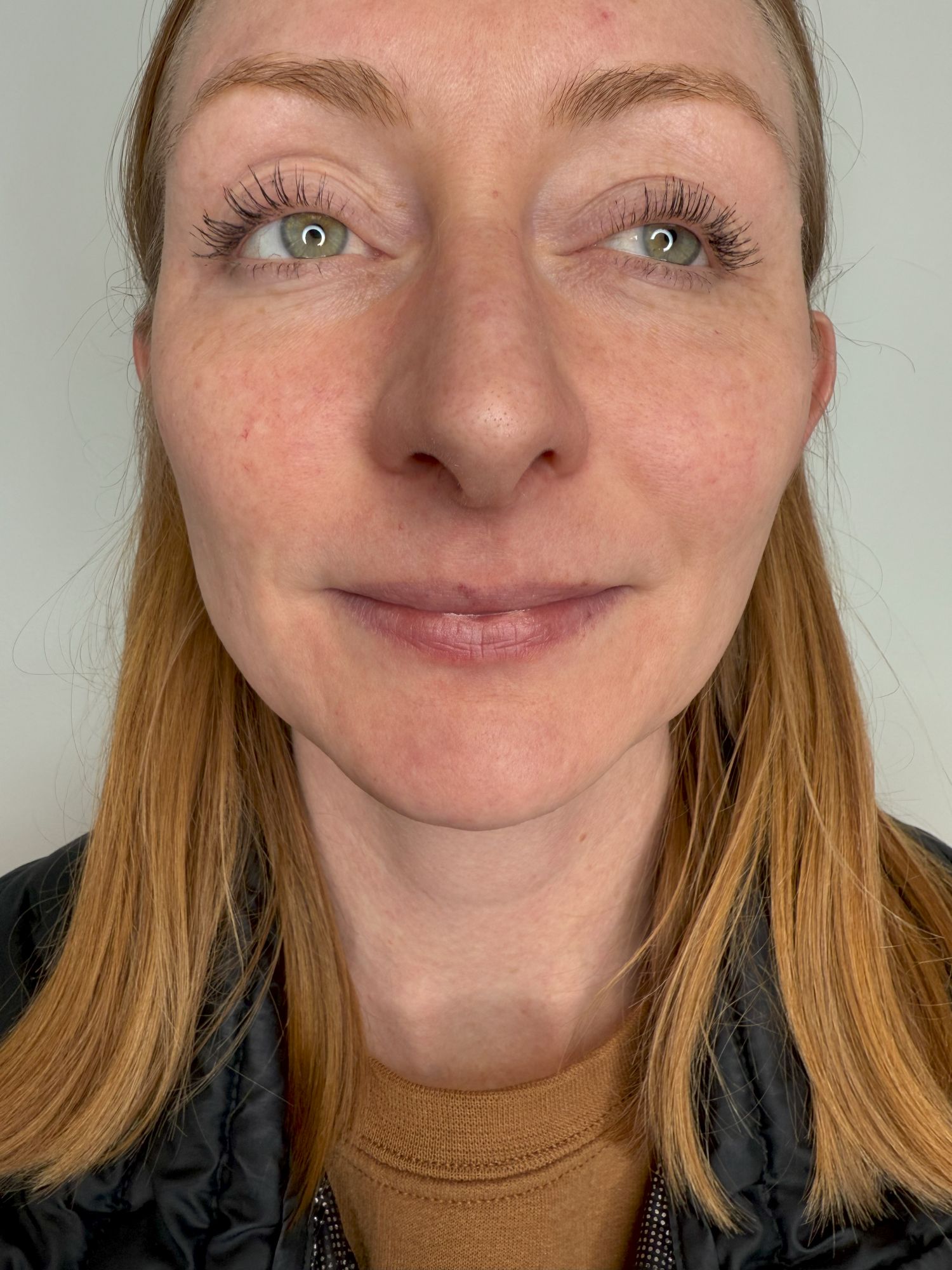 Lip Filler