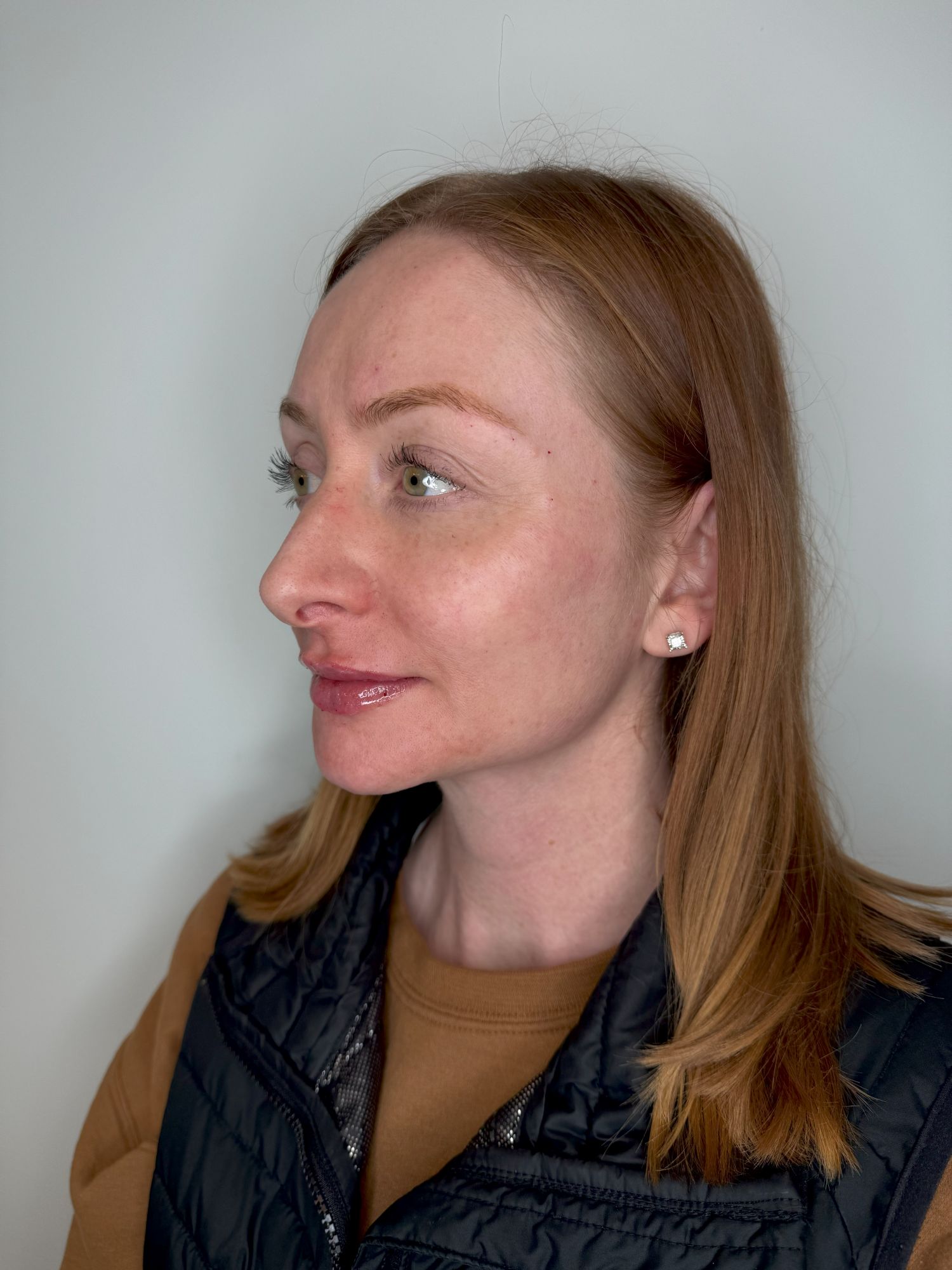 Lip Filler