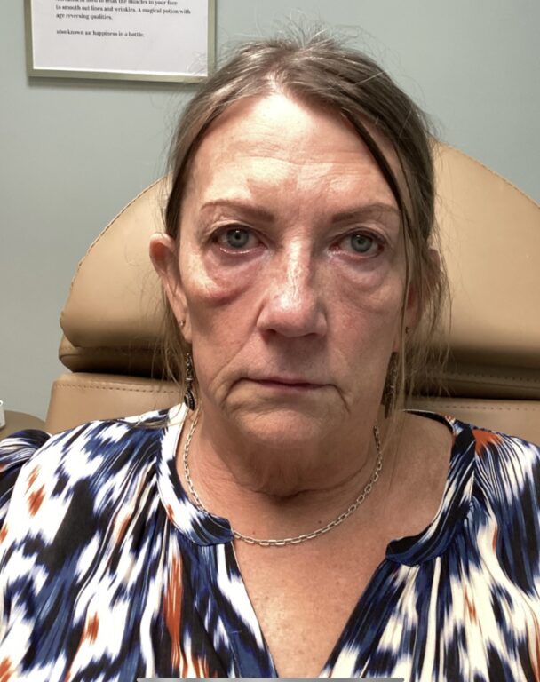 Radiesse Dermal Filler