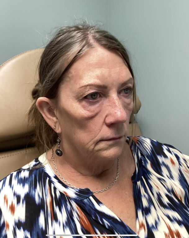 Radiesse Dermal Filler