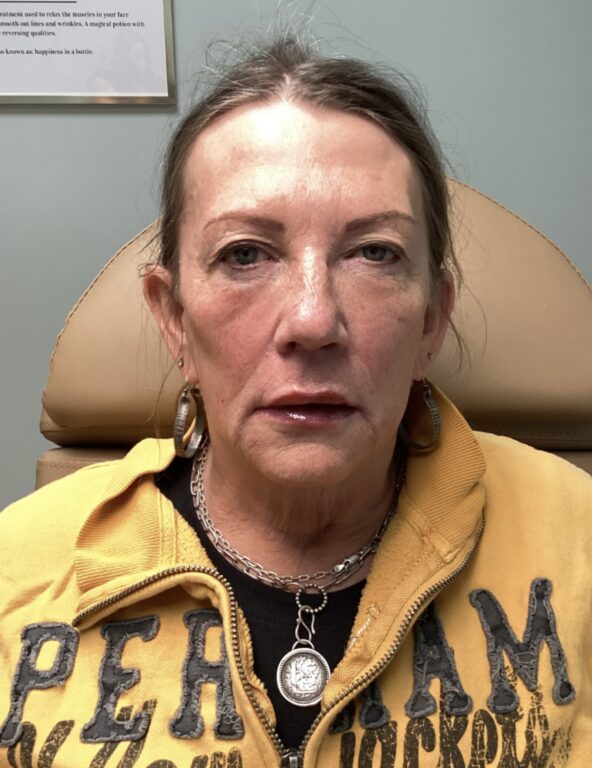 Radiesse Dermal Filler