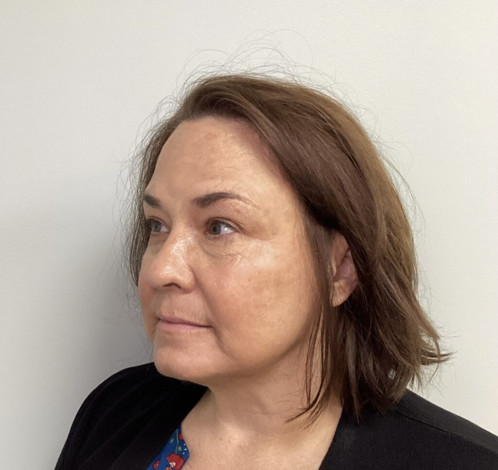 Rejuvenate your skin with IPL Photofacials. A safe, effective treatment for discoloration, sun damage, and signs of aging