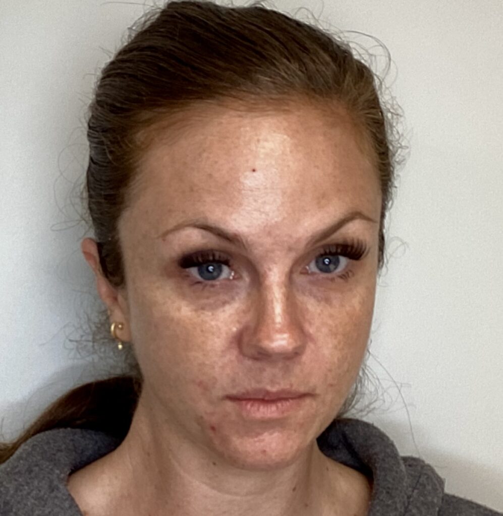 Erase years from your skin with CO2 Laser Resurfacing. Treat wrinkles, sun damage, and acne scars for dramatic, long-lasting results.