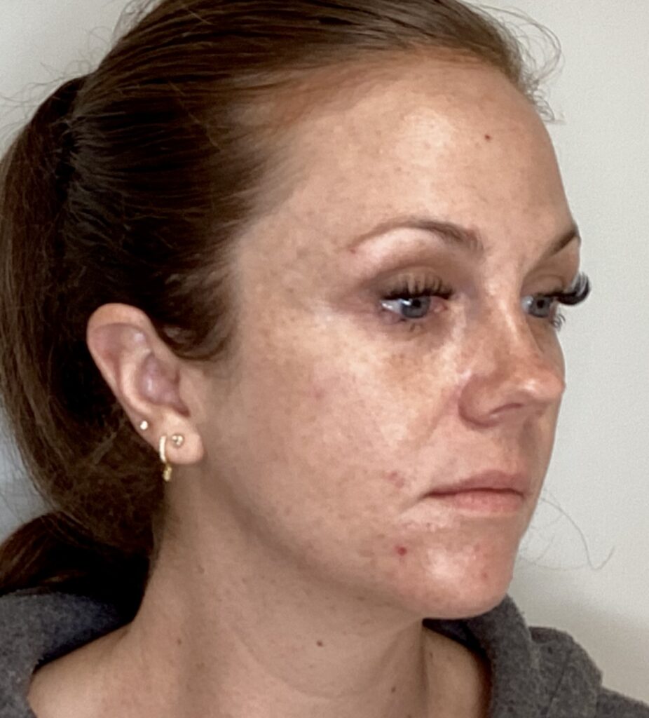 Before C02 Laser