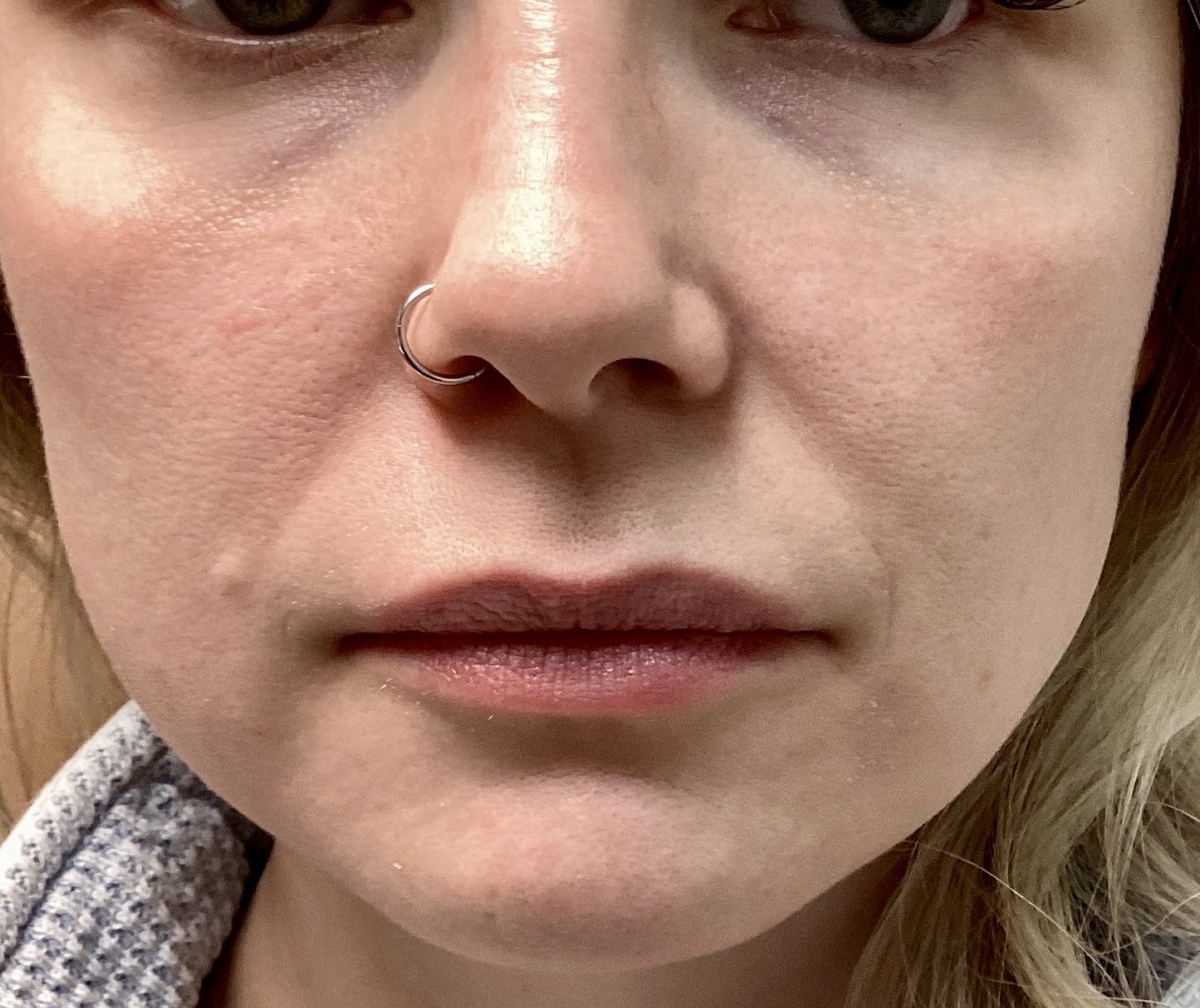 Restore youthful volume and shape with lip filler at The Skin Clinic. Personalized results that look naturally you.