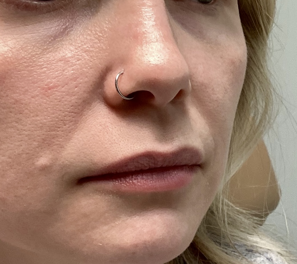 Restore youthful volume and shape with lip filler at The Skin Clinic. Personalized results that look naturally you.