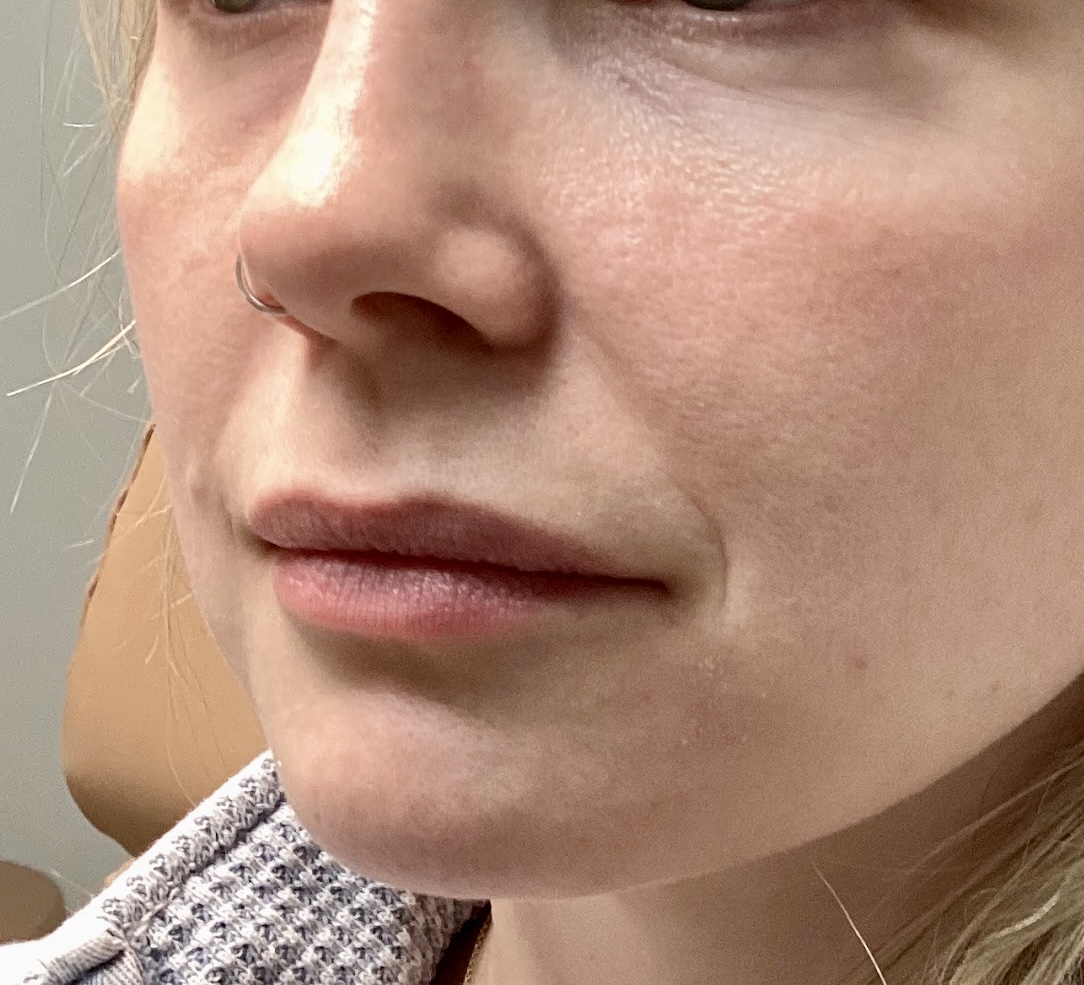 Restore youthful volume and shape with lip filler at The Skin Clinic. Personalized results that look naturally you.