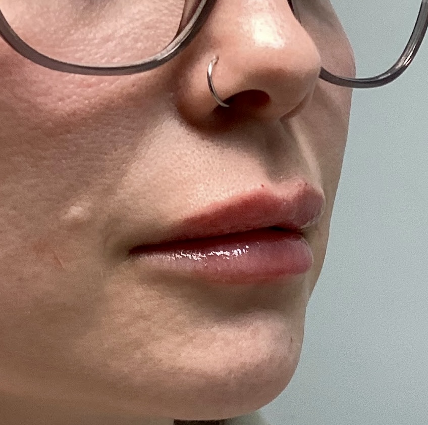 Restore youthful volume and shape with lip filler at The Skin Clinic. Personalized results that look naturally you.
