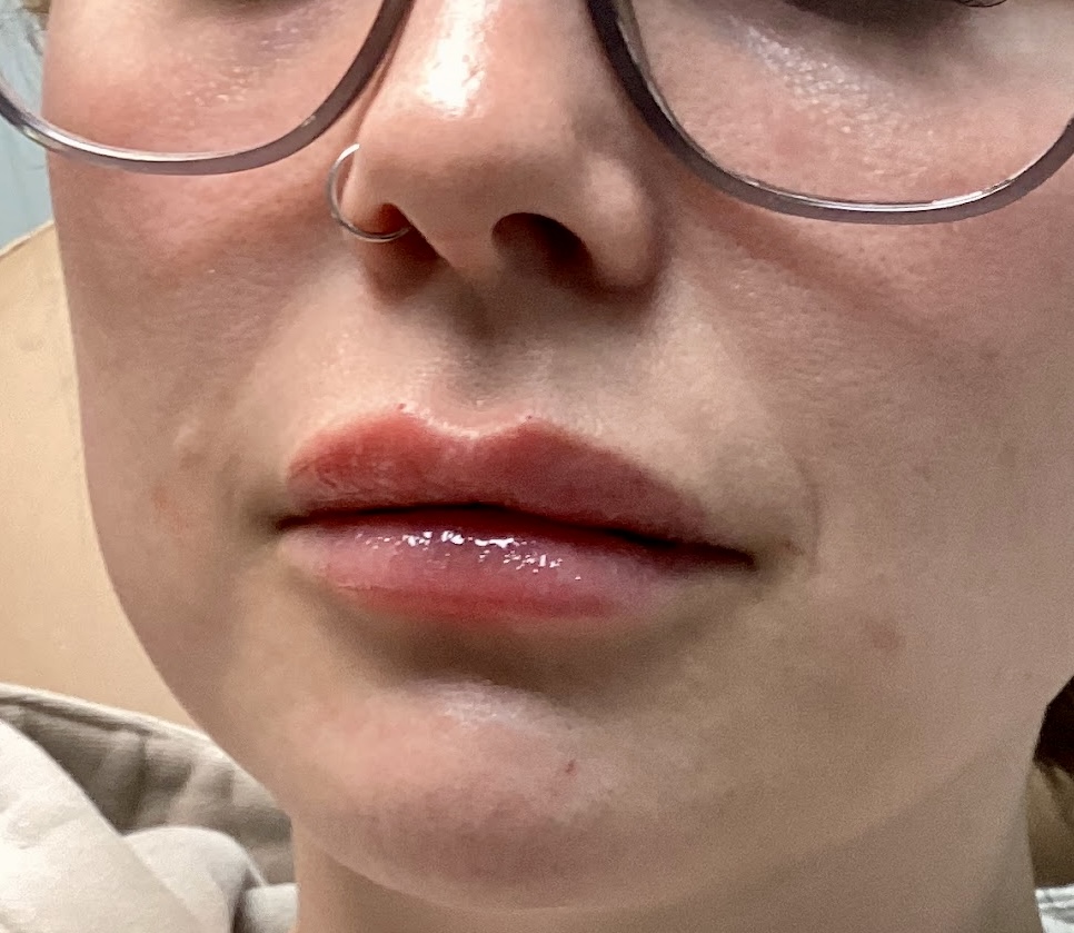 Restore youthful volume and shape with lip filler at The Skin Clinic. Personalized results that look naturally you.