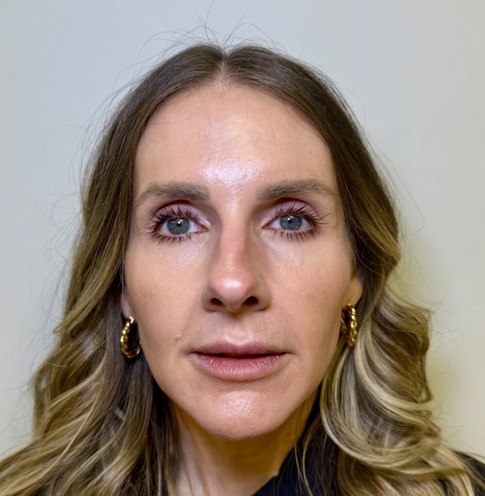 Dermal FIller Radiesse