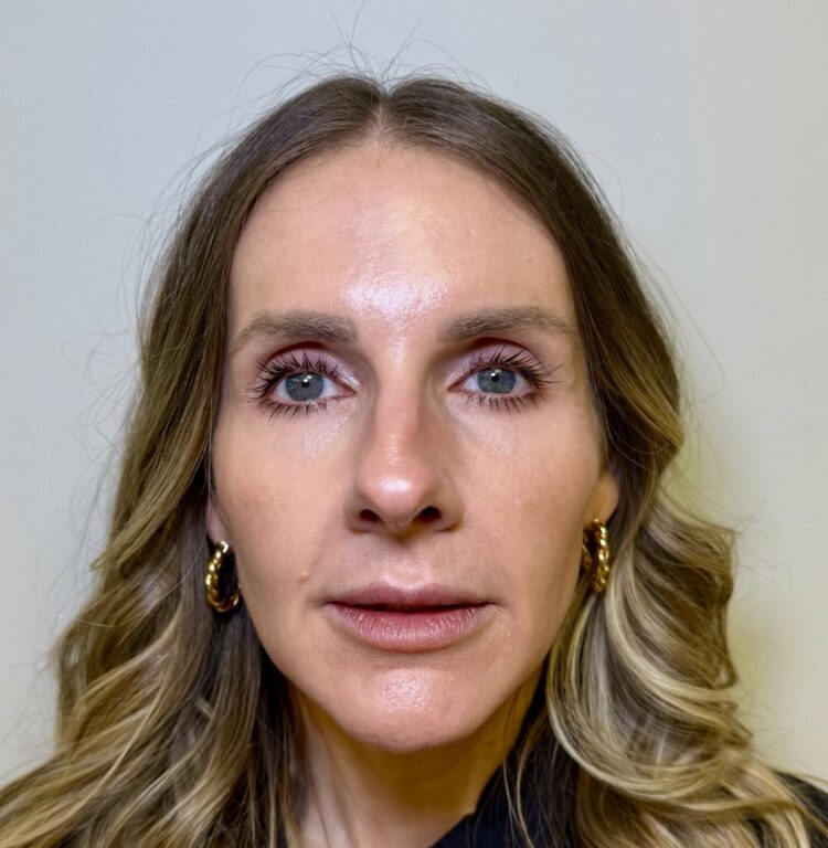 Dermal FIller Radiesse