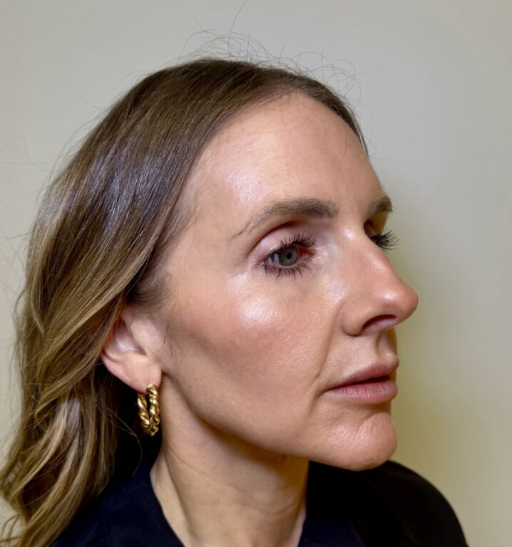 Dermal FIller Radiesse