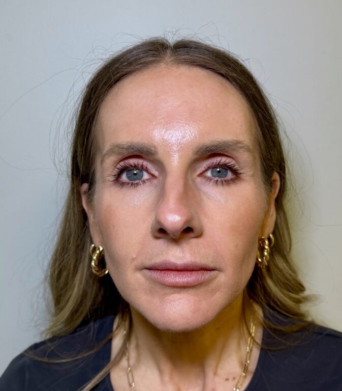Dermal FIller Radiesse
