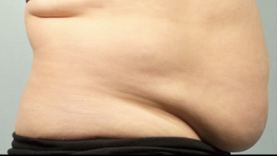 Permanently reduce stubborn fat with noninvasive SculpSure body contouring at The Skin Clinic in Mankato. No surgery, no downtime—just real results.