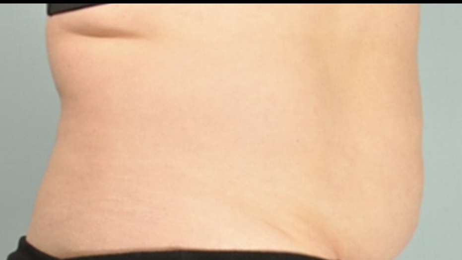 Permanently reduce stubborn fat with noninvasive SculpSure body contouring at The Skin Clinic in Mankato. No surgery, no downtime-just real results.