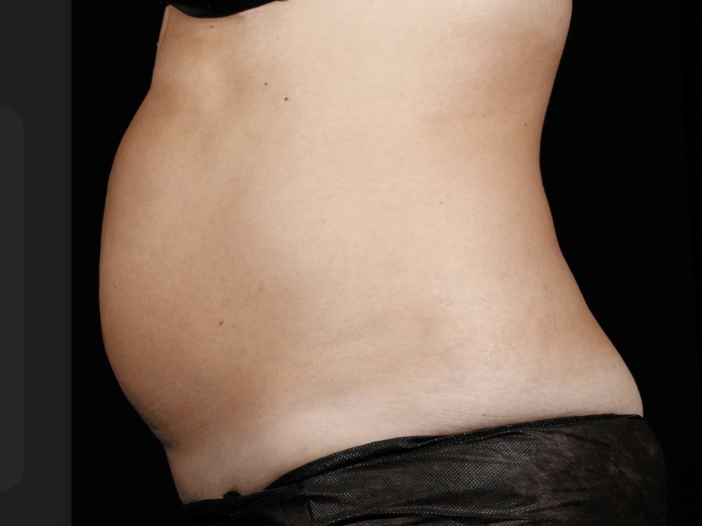 Permanently reduce stubborn fat with noninvasive SculpSure body contouring at The Skin Clinic in Mankato. No surgery, no downtime-just real results.