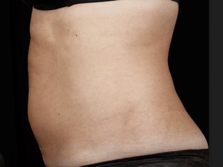 Body Contouring Mankato, Mn