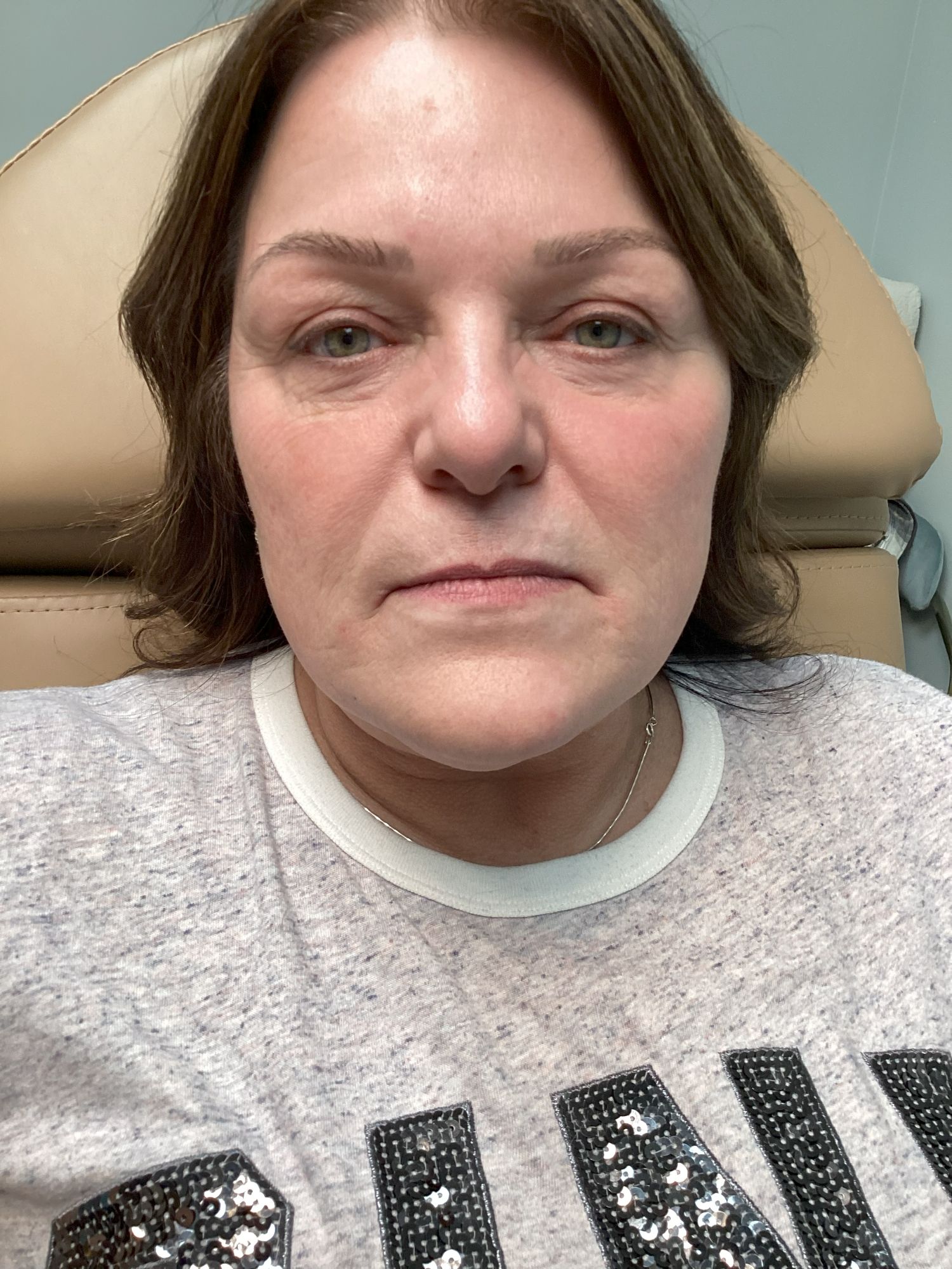 Dermal Filler Lip Filler
