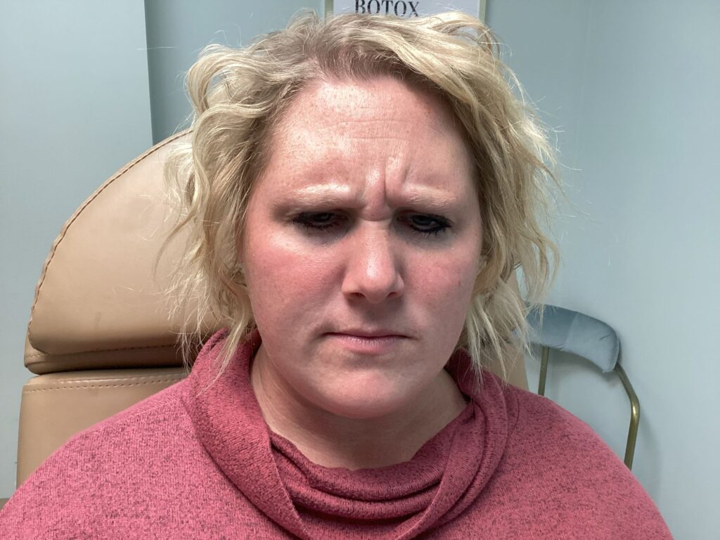 Botox treatment